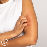 How to Treat PV-Related Itching