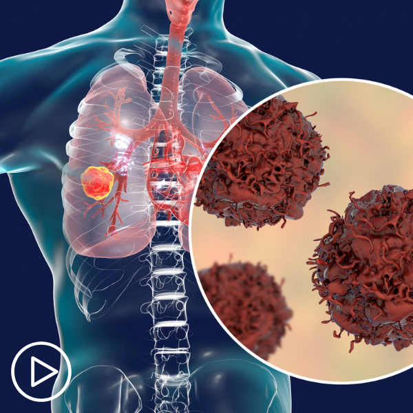 What Are the Advantages of Newer Lung Cancer Treatment Approaches?