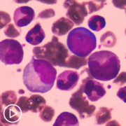 What Is FLT3-Mutated Acute Myeloid Leukemia