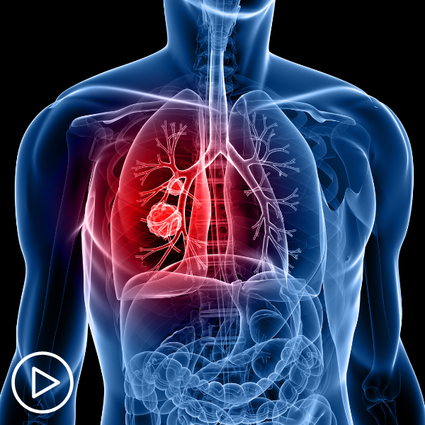 Establishing a Lung Cancer Diagnosis: How Do Subtypes Affect Treatment Choices?
