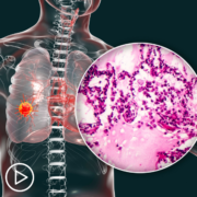 Exciting Lung Cancer Data and Studies_ A Look At Neoadjuvant Treatment