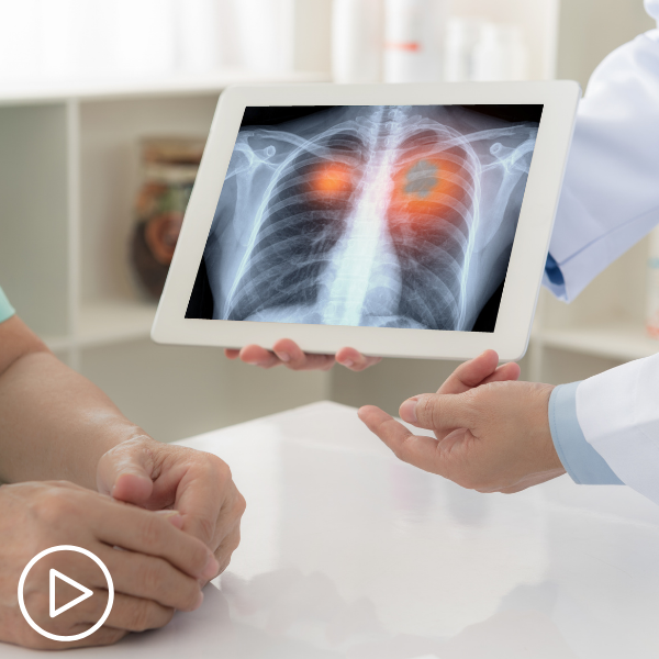 Immunotherapy for Lung Cancer Treatment: What to Expect