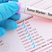 What Is a Prostate Cancer Biomarker