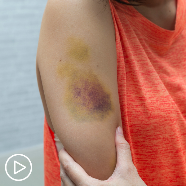 Why Does Bruising Occur in Chronic Lymphocytic Leukemia?